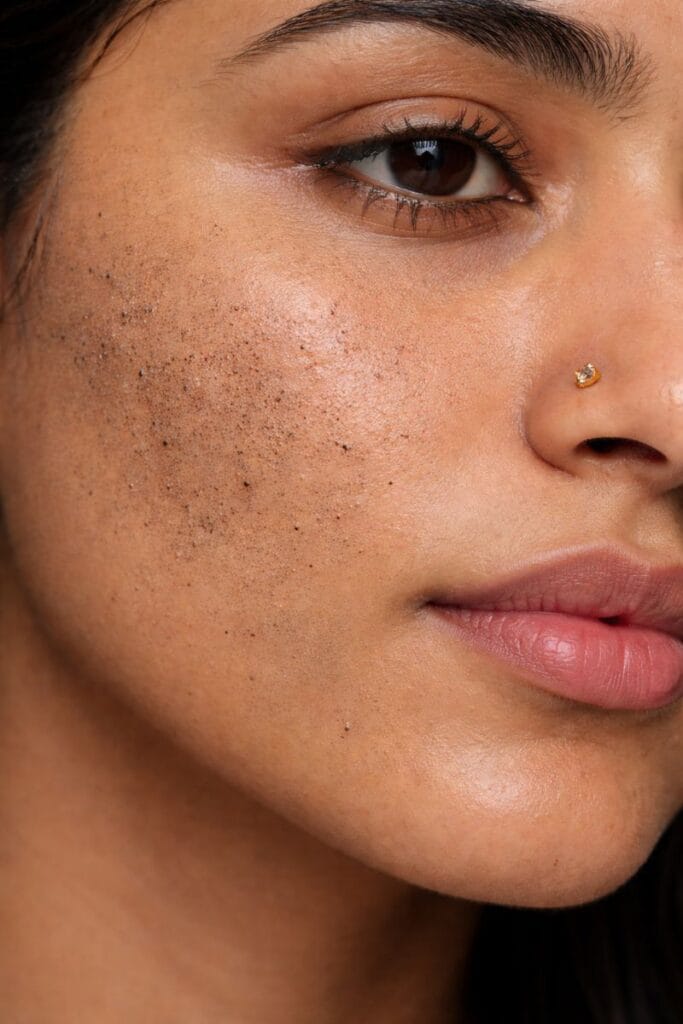 clogged pores